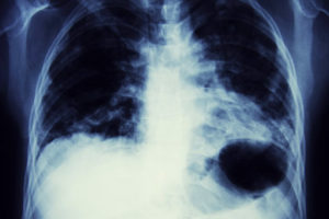 an X-ray of a chest