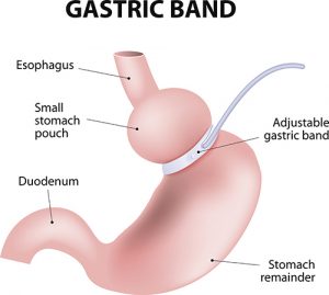 Diagram of an adjustable gastric band