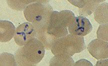 Babesia microti is a protozoan that parasites red blood cells, causing anemia