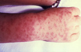 Child's right hand and wrist displaying the characteristic spotted rash of Rocky Mountain spotted fever.