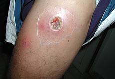 skin lesion on arm